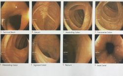 タイで大腸がん検査をしました。検査の内容とかかった費用